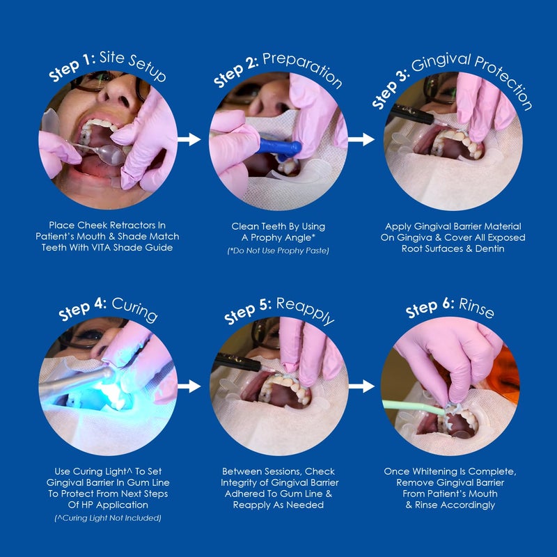 Whiter Image Professional Dental Grade Gingival Barrier Syringe Kit - Easy Apply & Remove, Maximum Gum Protection for Teeth Whitening Procedures, Made in USA, Includes 4 Syringes & 8 Needles - Image 3